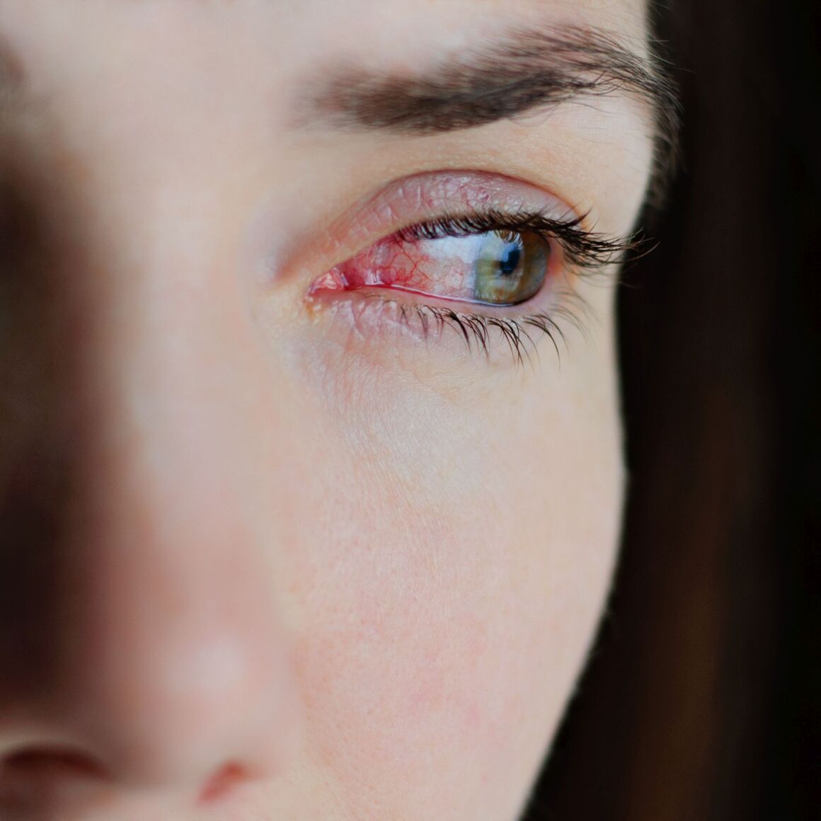 Nahaufnahme von gereizten oder infizierten roten, blutunterlaufenen Augen